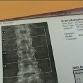 osteoporosi-1